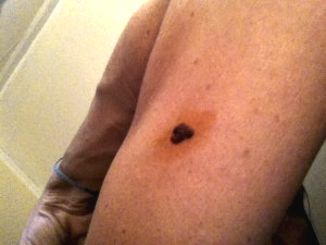 Mole with iodine applied on and around