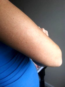 My mole is now gone