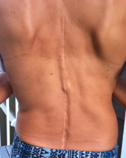 30 year old scar from spinal fusion surgery for scoliosis. You can see the steel rod jutting out in the middle.