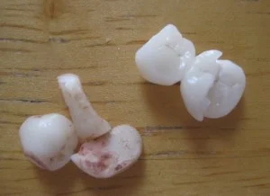 Crowns that came out; one was in bad shape; all had metal