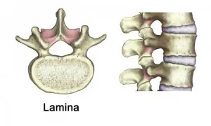 lamina-from-cedars-sinai-300x180.jpg