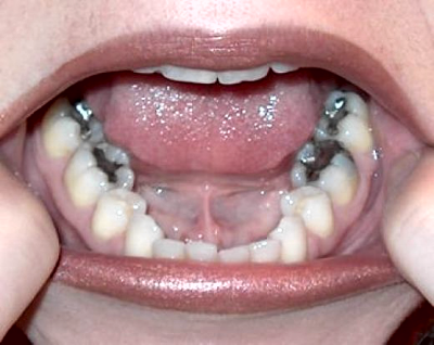 Amalgams are 50% mercury Photo: evolvedental.com.au