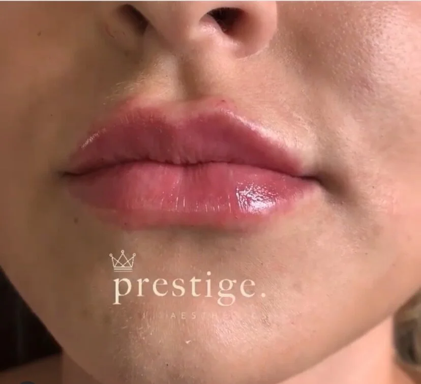 JUVERDERM LIPS 0.5ML