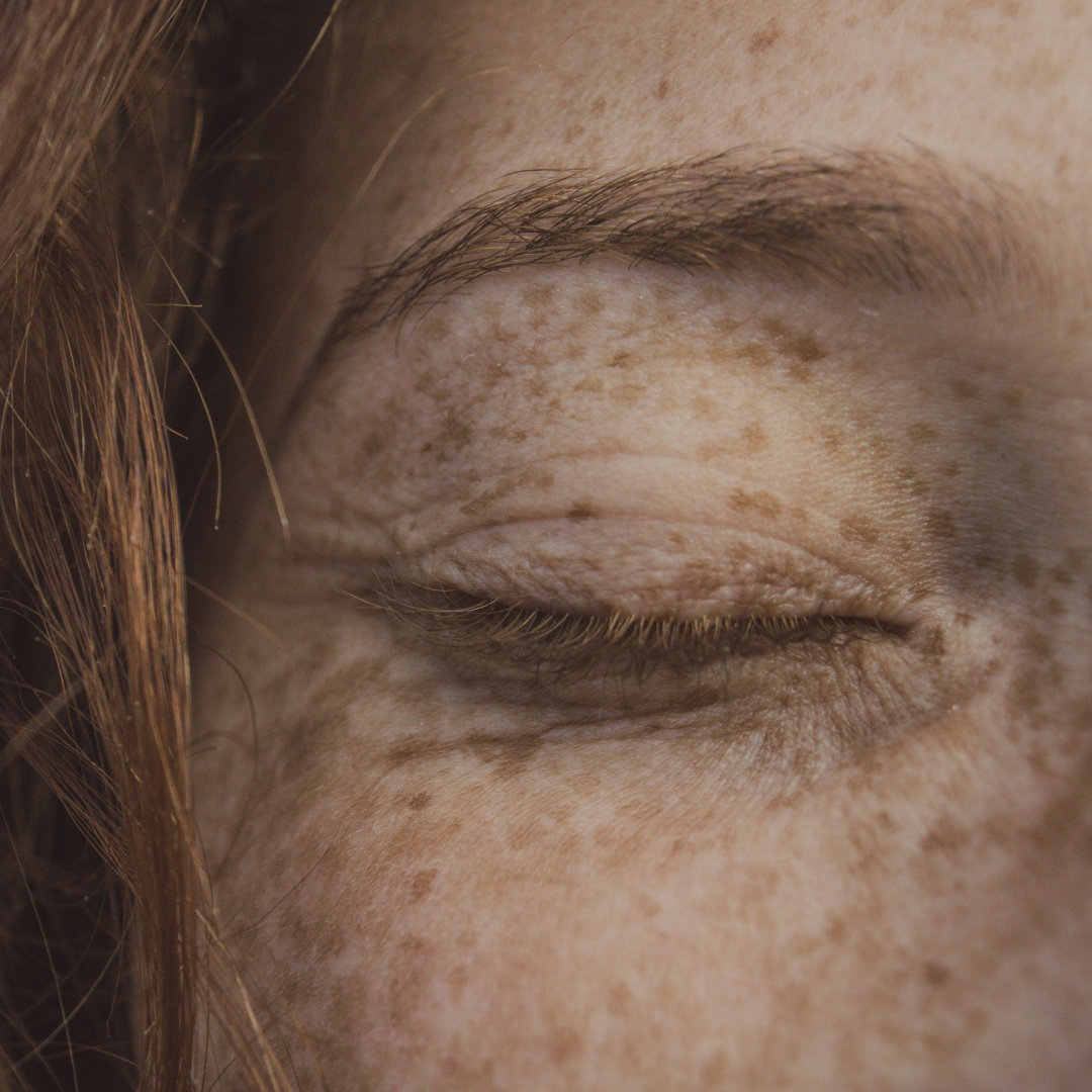 Illuminating the Effects of Melasma (And Other Forms of Hyperpigmentation)