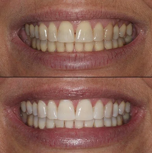 Before and after professional teeth whitening showing a noticeably brighter smile following treatment.