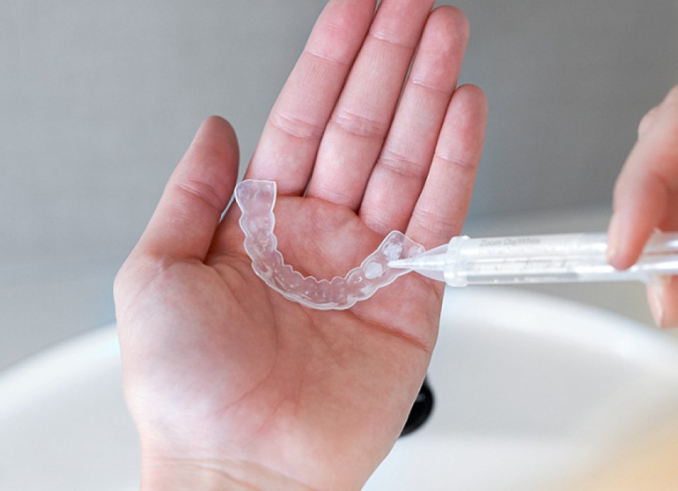 Professional custom whitening trays designed for safe take-home teeth whitening.