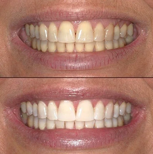 In-Chair vs Take-Home Teeth Whitening: Which Option Is Right for You?