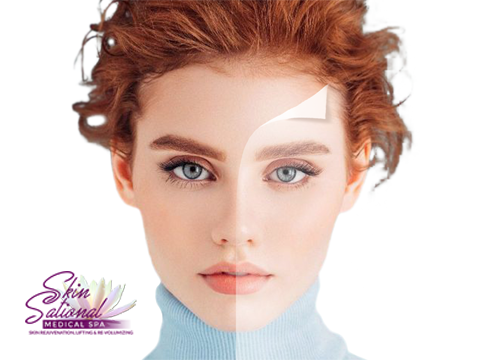 Jessner's Peel: A Chemical Peel With a Long Track Record of Success