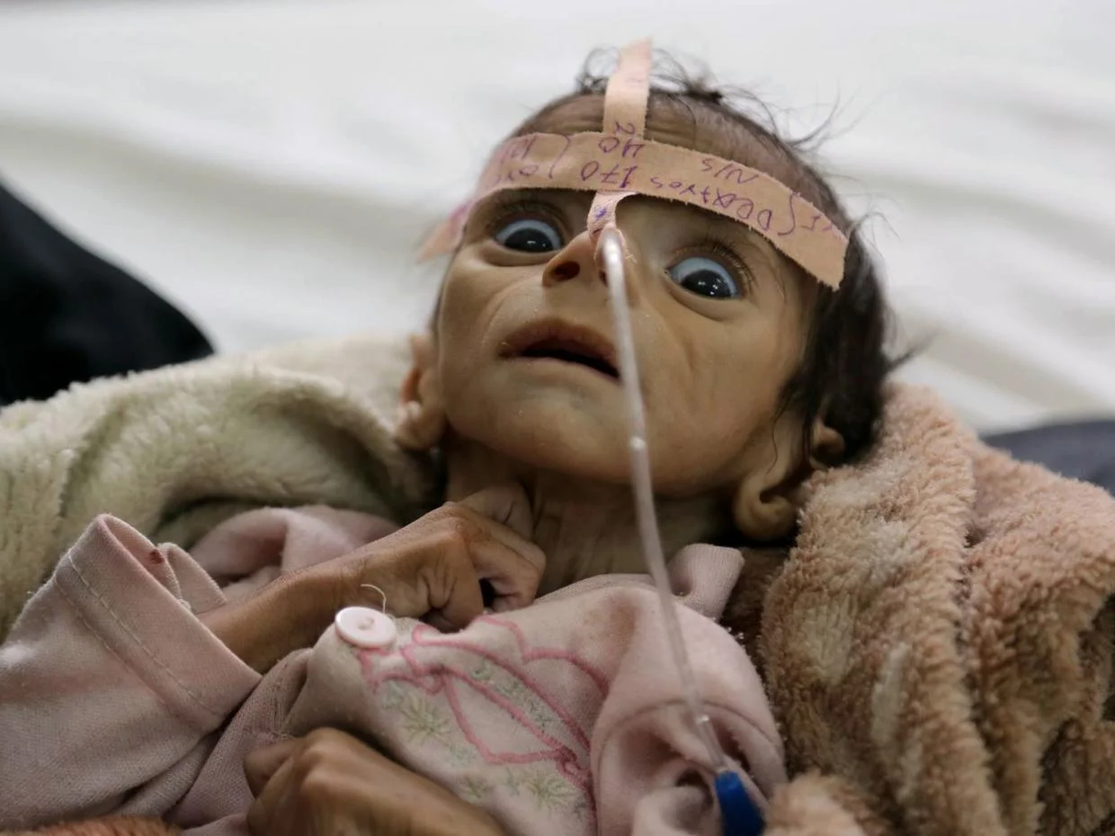 Udai Faisal, two days before his death from malnutrition in al-Sabeen hospital in Sanaa, Yemen