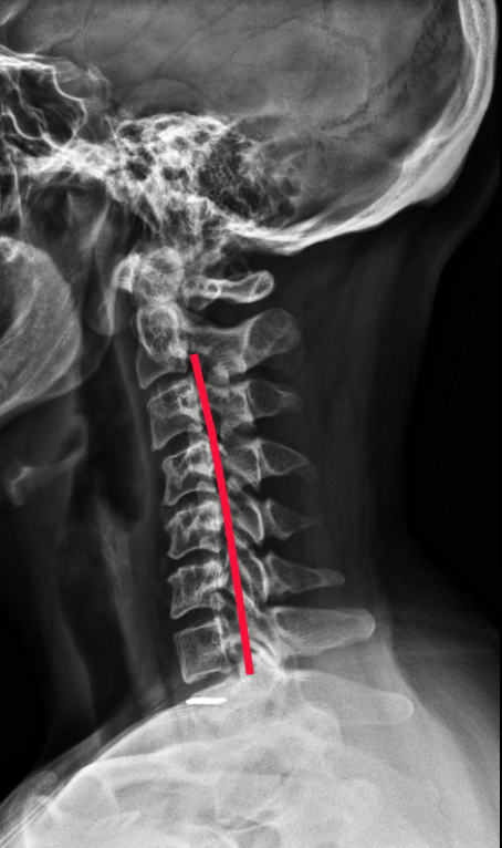 Pre-Care: An untreated patient x-ray showing abnormal degrees forward-tilting vertebral misalignment of the cervical spine