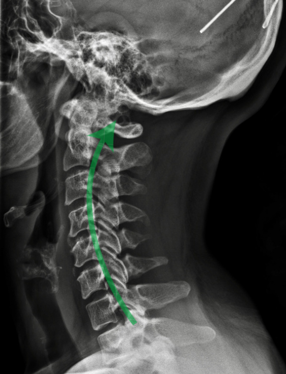 Digital x-ray of a patient who received 12 months of full Corrective Chiropractic Care. The healthy backward curve of the cervical spine indicates normal spinal mechanics and healthy alignment of individual vertebrae throughout the neck