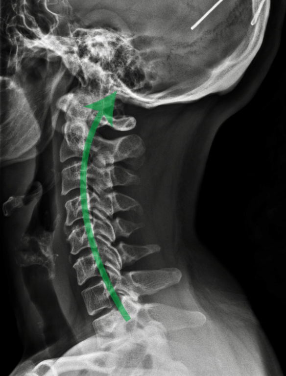 Common physiological symptoms of cervical spine misalignment include: tension, fatigue, headaches, mobility challenges, and localized or general pain symptoms and that are often indicative of additional misalignment throughout the entire spine