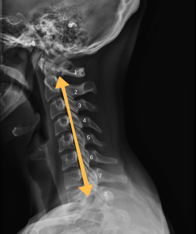 The neutral position shows a loss of the normal C-Shaped curve, therefore placing the neck in a vulnerable position for injury