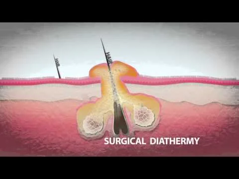 Sebaceous Gland Ablation SGA - the permanent Acne, Pimple & Breakout solution