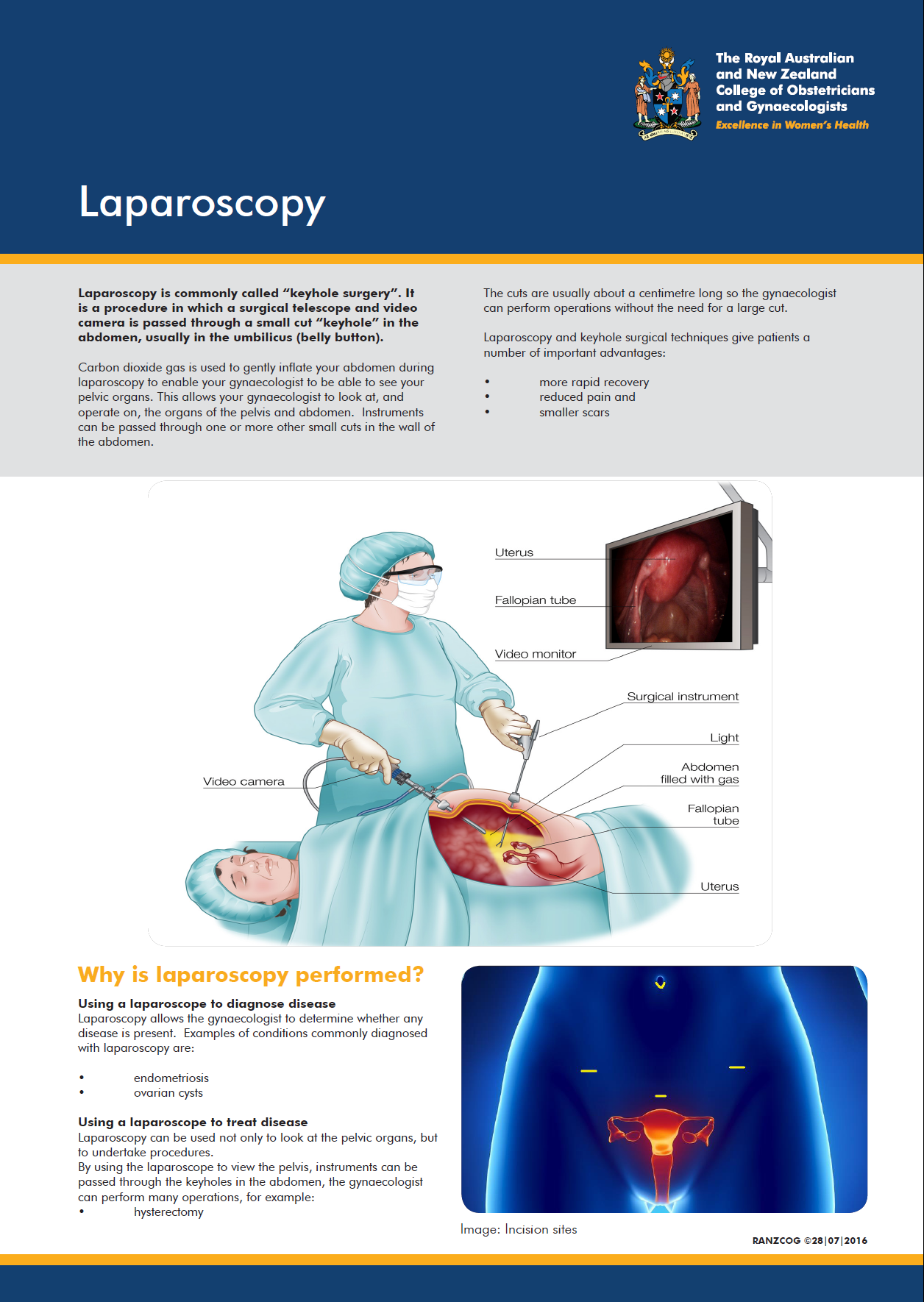 Laparoscopy.png