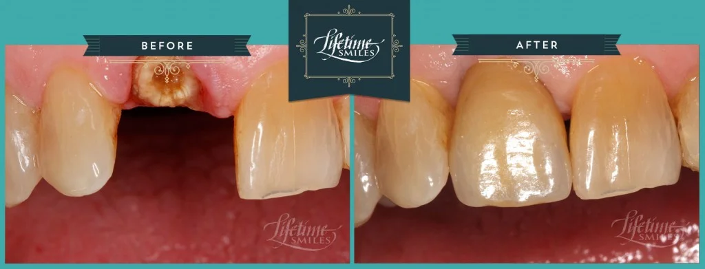 Front Implant