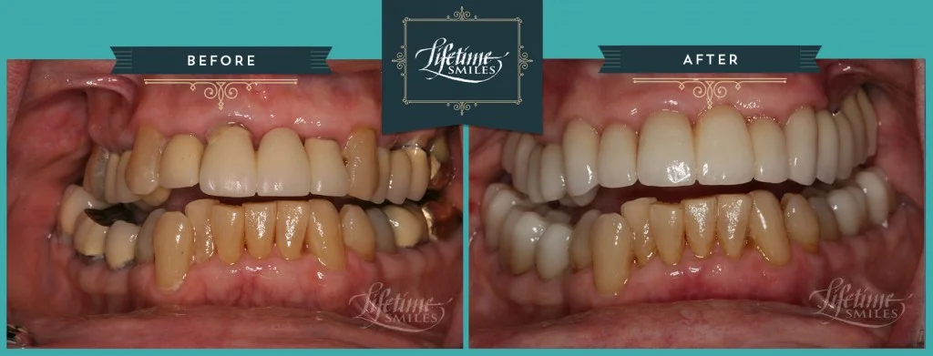 Implant / Crowns