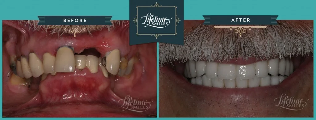 Complete rebuild on implants