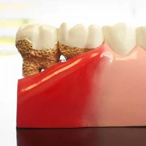 square-gum-disease1-300x300.jpg