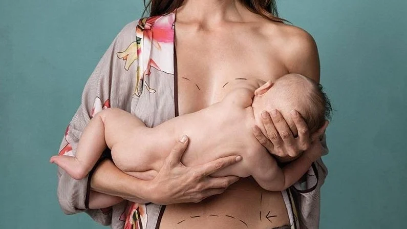Mommy makeover: rehaciendo la imagen corporal de Mamá.