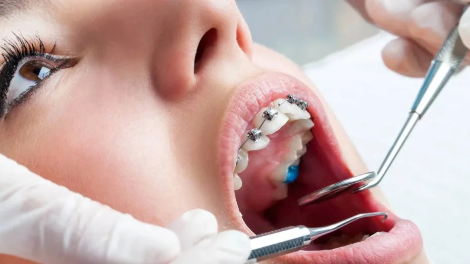 ¿Tengo que utilizar brackets?