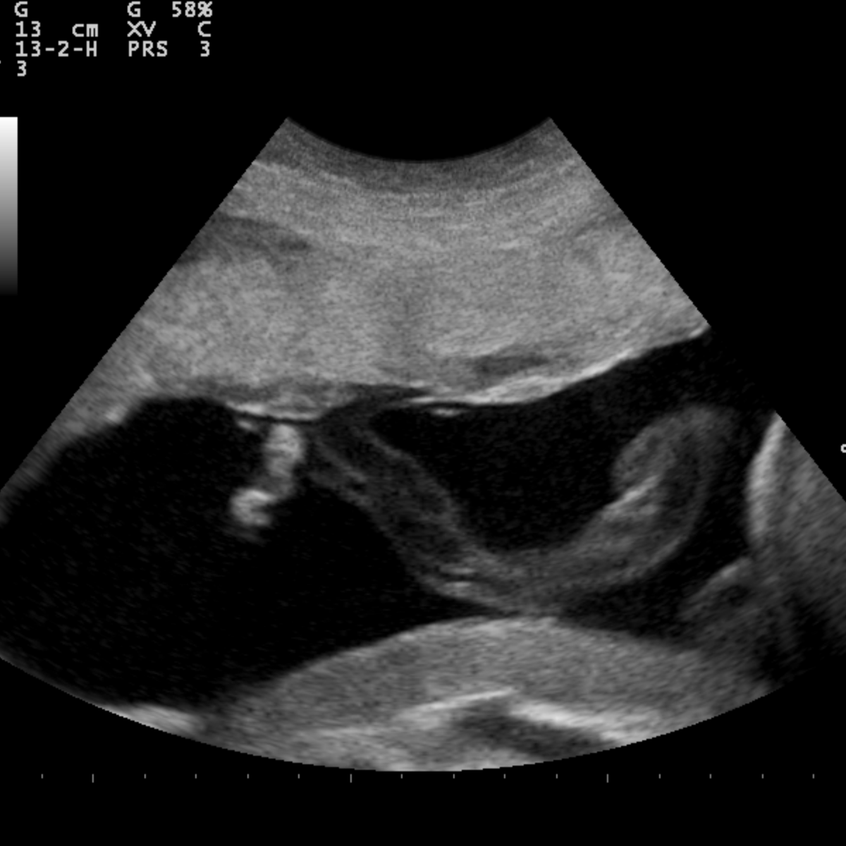 S4.20 Baby boom: The surprising science of the placenta