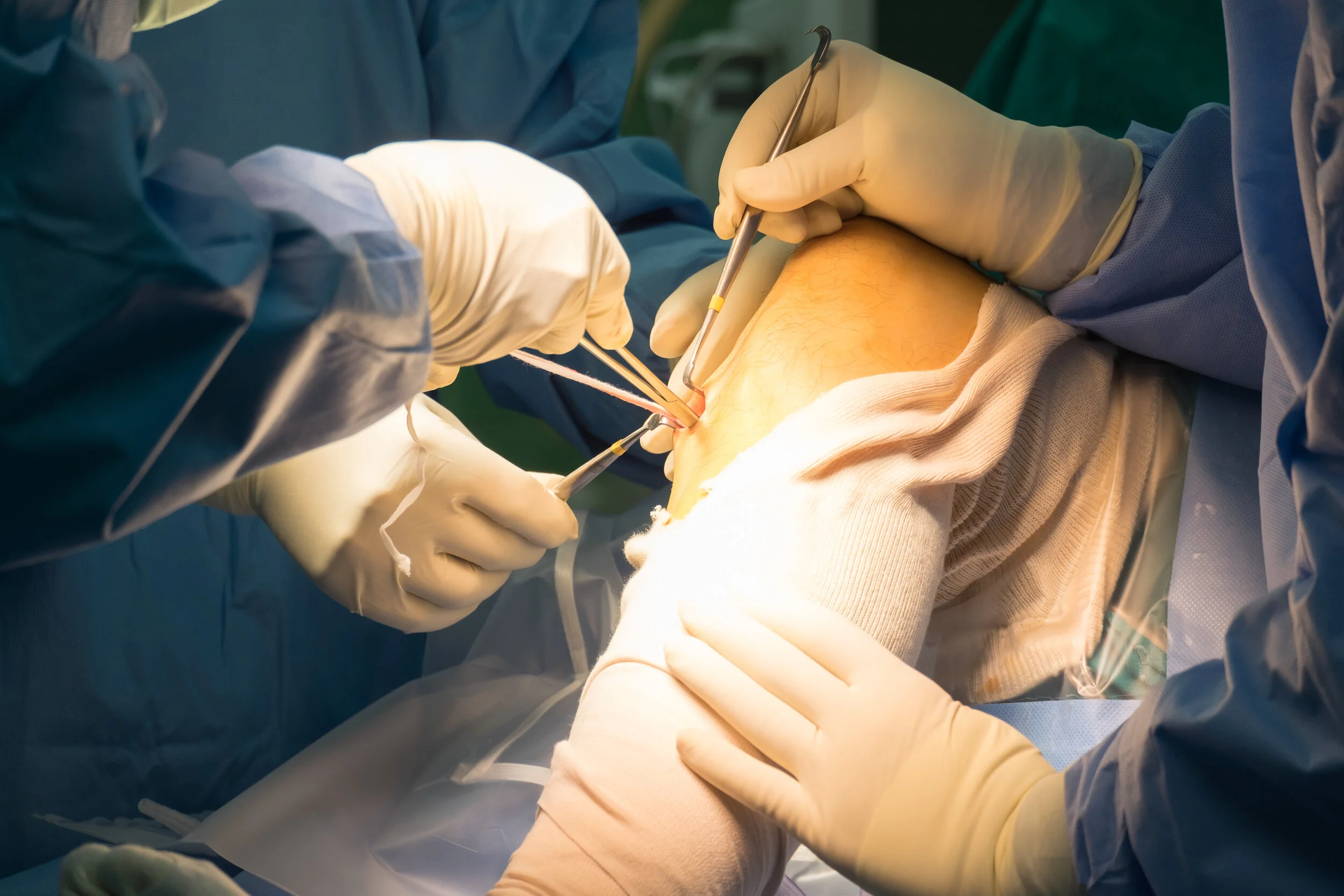 What to do after an ACL reconstruction?