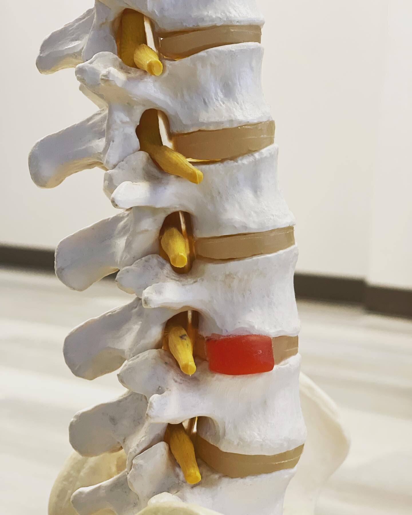 How long for this to heal(disc herniation)?

You&rsquo;d be surprised

#physiotherapy #physicaltherapy #backpain #sportsphysio #fisioterapia #fisio #science