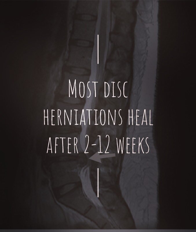 One common source of back pain are disc herniations. Most discs heal with time! So you really don't have to worry.🙂

Physio is only recommended after 3-4 weeks of continuous pain. Proper patient education and exercise may help! 👍

MRIs may sho