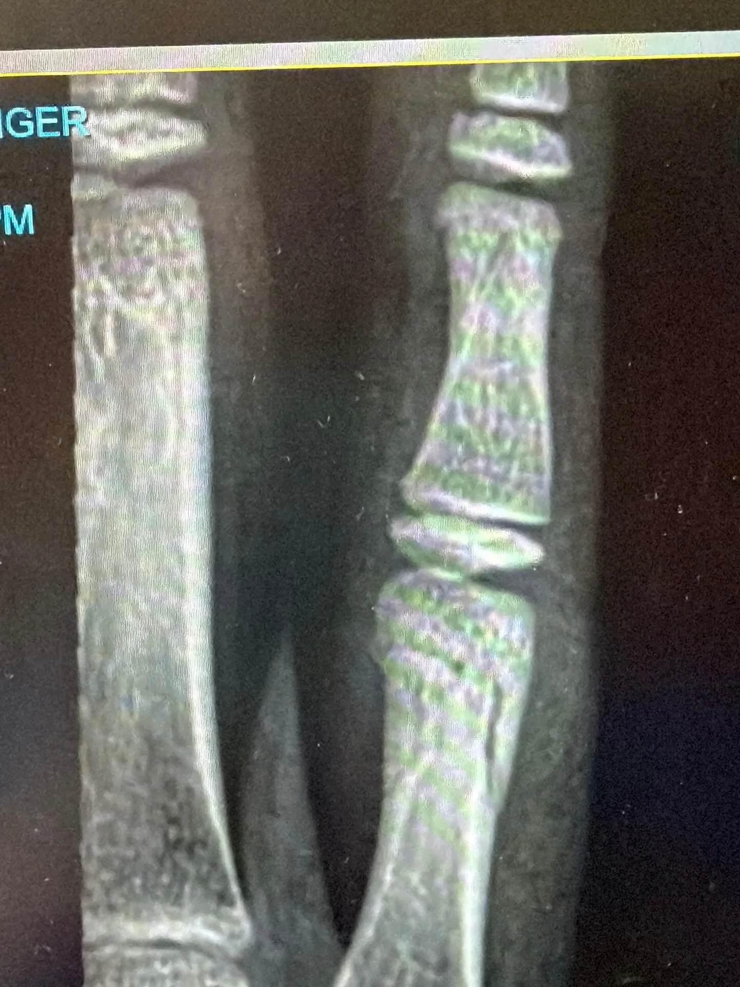 It&rsquo;s been a week.

1. Paediatric proximal phalanx oblique fracture
2. ☕️ 
3. Don&rsquo;t ruin a good day today by thinking about a bad day yesterday 
4. THTG Airport Oaks
5. Always learning
6. Ponsonby views 
7. All the splints 

#healthyminds 