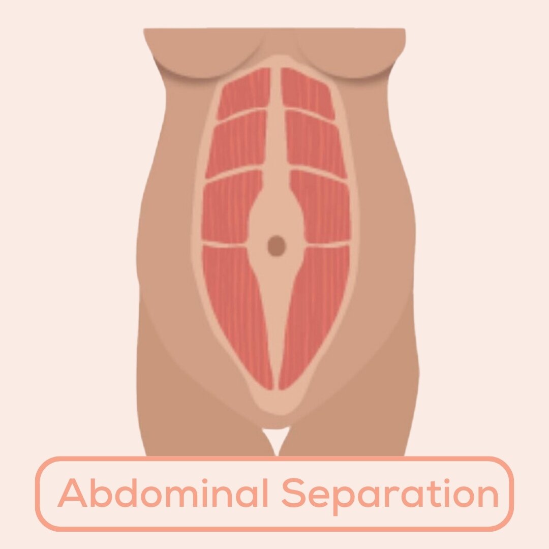 Chances are that if you are pregnant you have heard of the term Abdominal Separation. Abdominal Separation otherwise known as Rectus Diastasis or Diastasis Rectus Abdominis Muscle (DRAM) is a normal process that happens during pregnancy in order to l