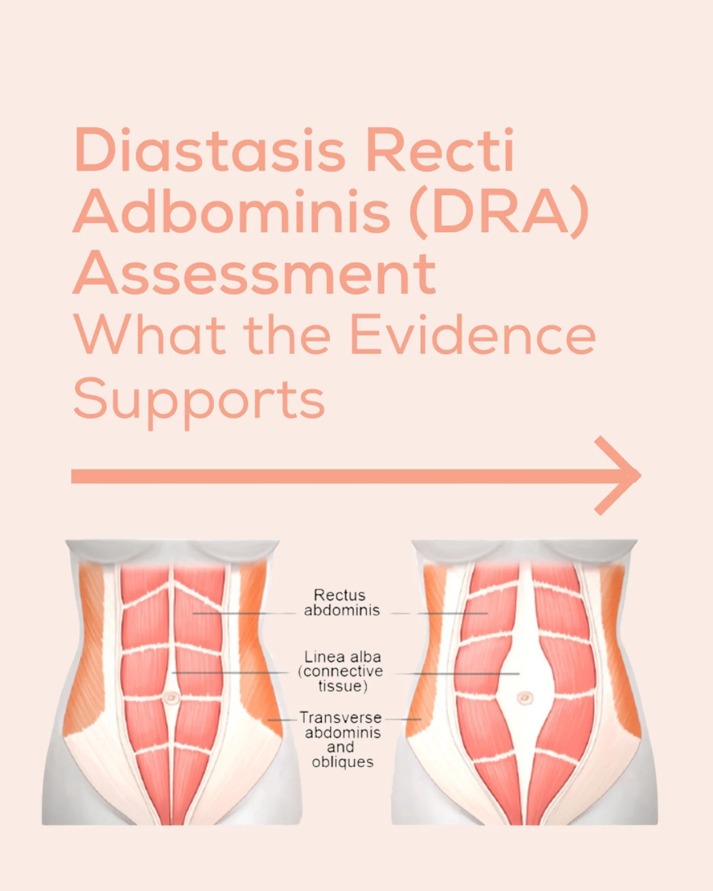 More than just the gap 💪

Current evidence shows there is no single cut-off that defines diastasis recti abdominis (DRA) which is why assessment needs to look beyond just measuring separation.

When assessing DRA, women&rsquo;s health physiotherapis