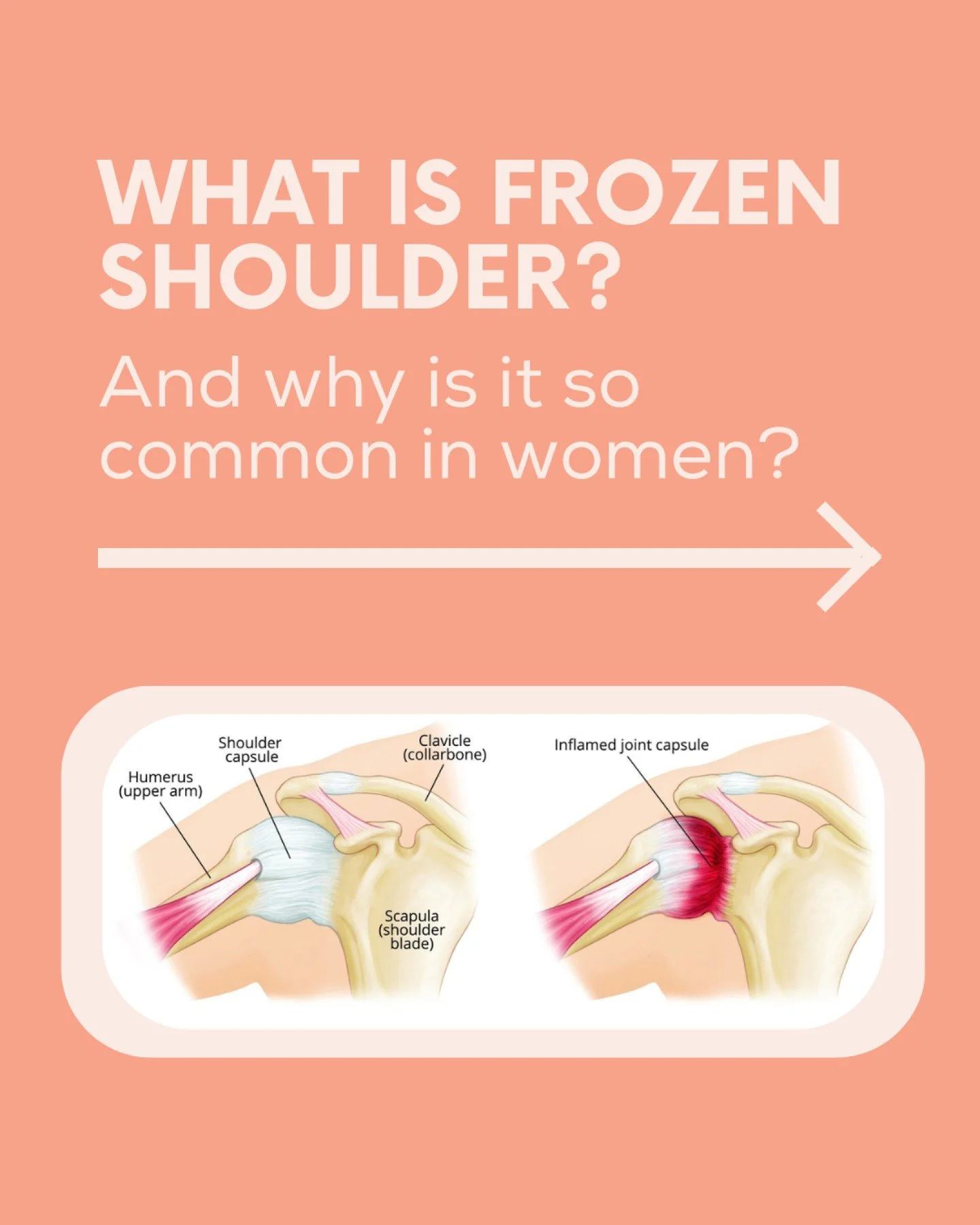 Shoulder Pain OR Frozen Shoulder 💪

Frozen shoulder, also known as adhesive capsulitis, is a condition where the shoulder joint becomes stiff, painful and difficult to move. It often develops gradually and can last months to years if not managed app