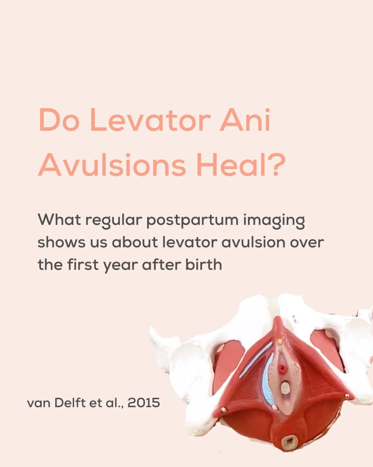 What happens to an avulsion after birth?

Levator ani avulsion is often discussed as a significant birth-related pelvic floor injury, but newer imaging research reminds us that recovery is not always straightforward.

In this prospective study, trans