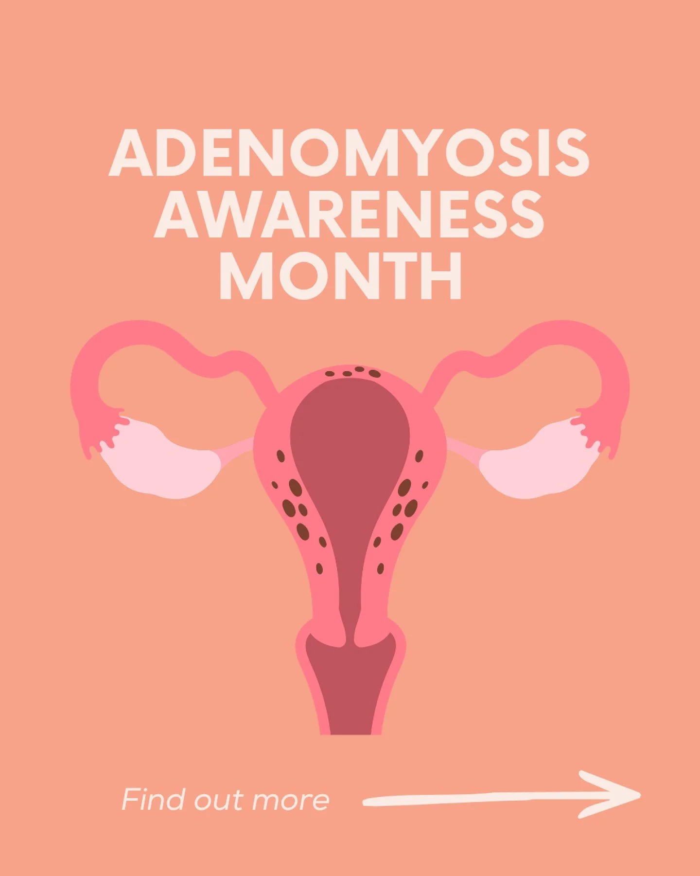 Adenomyosis Awareness Month 💛🌼

Adenomyosis is more common than many realise, yet often under-recognised.

It occurs when tissue similar to the uterine lining grows into the muscle of the uterus, which can lead to changes in the size and function o