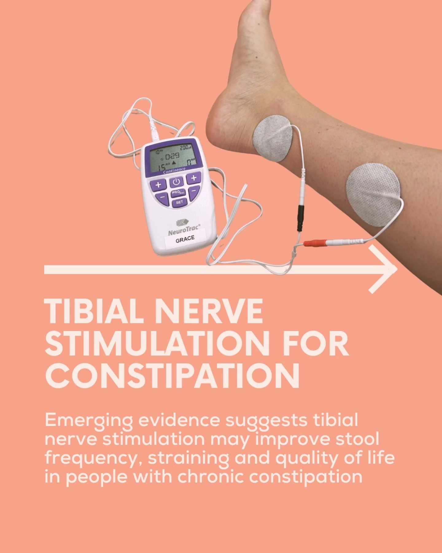 Neuromodulation for Constipation 

A recent systematic review found that both Transcutaneous tibial nerve stimulation (TTNS) and Percutaneous tibial nerve stimulation (PTNS) appeared to improve symptoms such as stool frequency, stool consistency, str