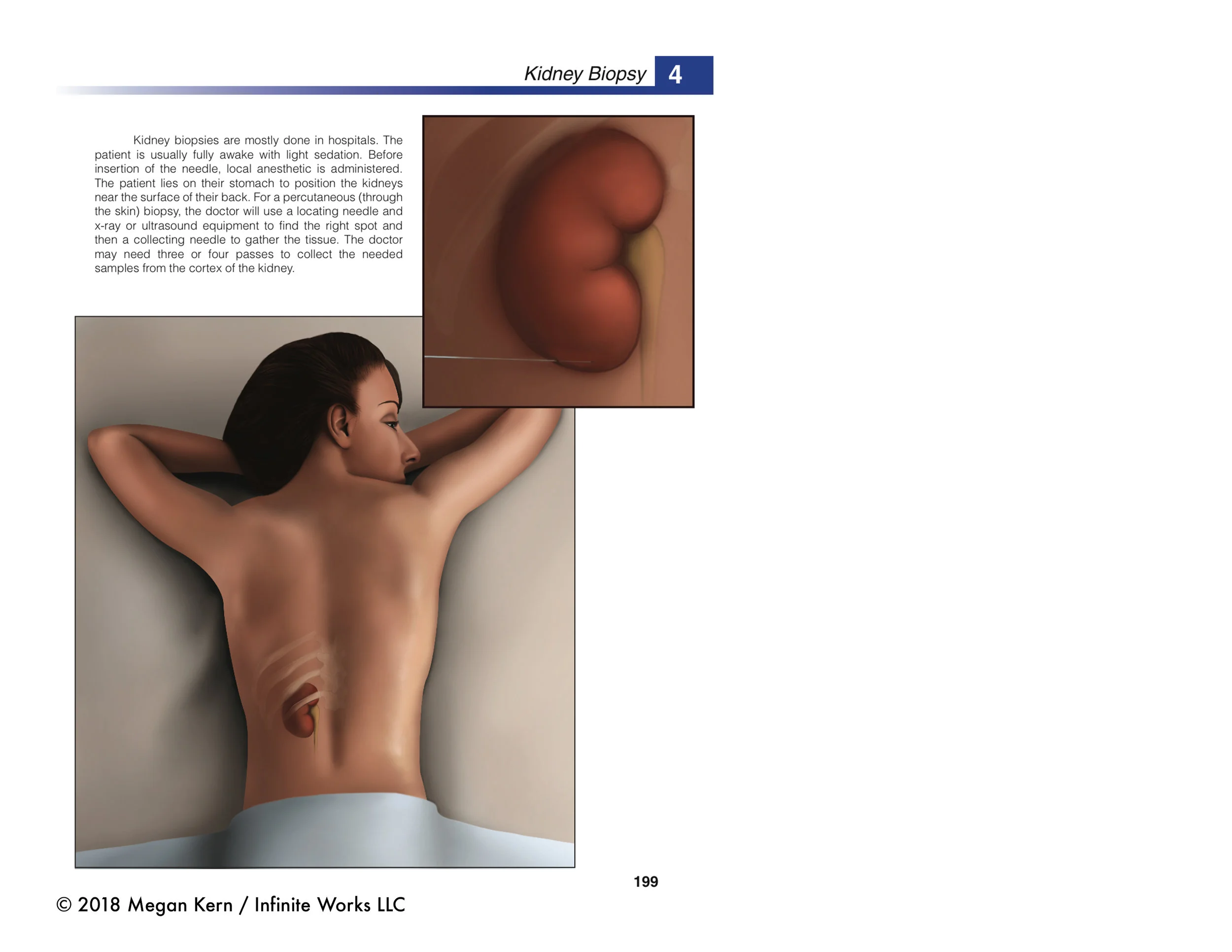 Kidney Biopsy Mock Up