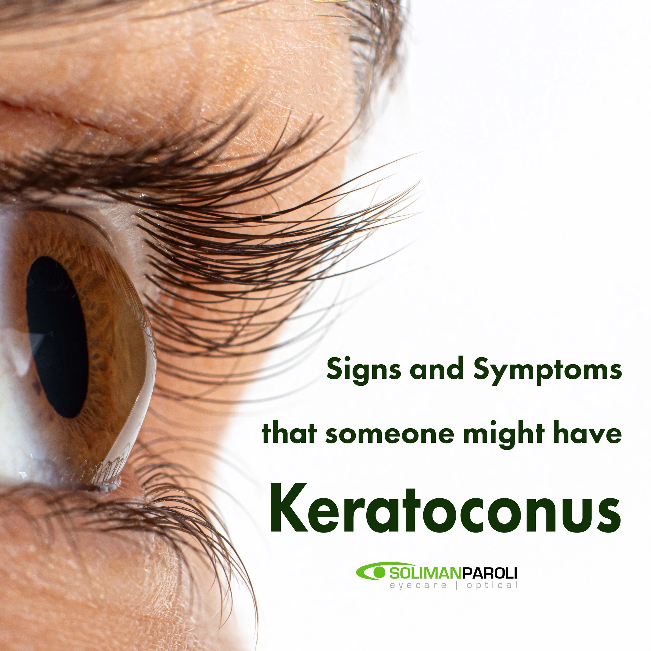 5 signs and symptoms that someone may have Keratoconus