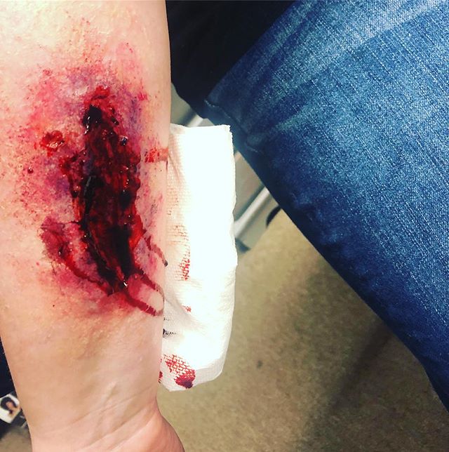 &ldquo;Don&rsquo;t go breakin&rsquo; my...&rdquo; arm?
@psstbridgette 
Done at @echoesoftimevb 
Products- @alconefx Third degree 
@spirithalloween Scab blood
@kryolanofficial dark blood
And of course alcohol makeup!! .
.
.
.
.
.
.
#wound #cut #scab #