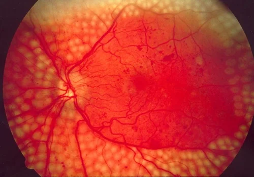 September+2017+diabetic-retinopathy.jpg