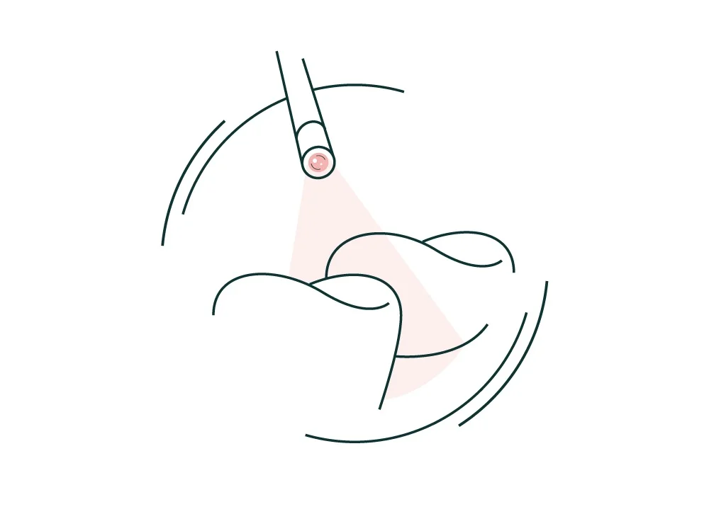 Gum treatment and perioscopy