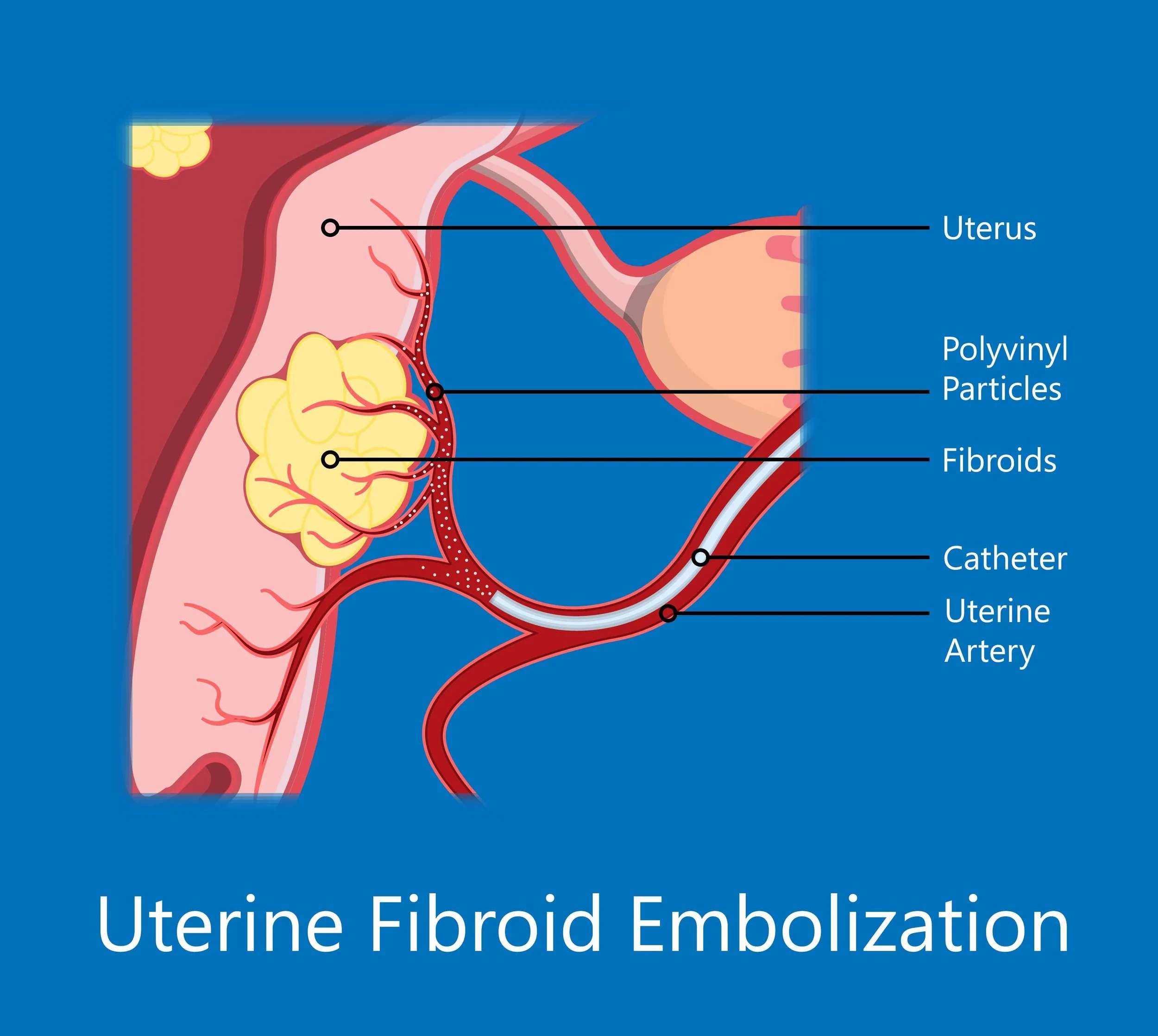 THE SAD TRUTH ABOUT HYSTERECTOMIES — The Atlanta Fibroid Clinic