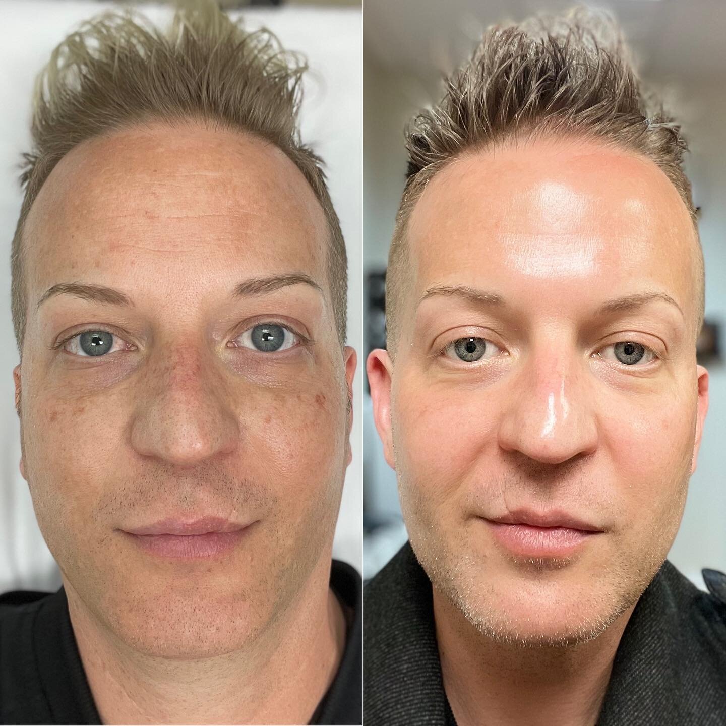 Wow, 2 years into my Aesthetician life and loving my own personal progress! 

Procedures/Treatments in the last 2 years include:

3 Fibroblast Treatments
3 Microneedle with PRP
TCA Chemical Peel
3 PRX Glow Peels
3 MIRApeel Treatments.

Plus the amazi