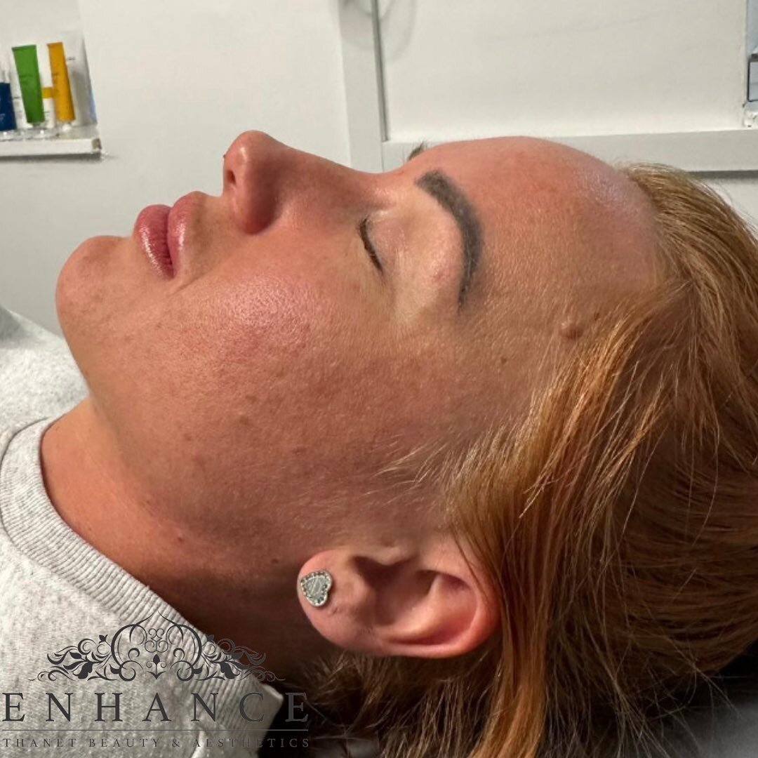 Nose tip lift 😍 

Loving this before and after swipe to see the before ➡️

Lift and enhance your side profile with our tip lift 🔥🔥

▫️Enhance Aesthetics 
▫️Kent Clinic 
▫️Book via our link 
https://enhancethanet.book.app/book-now

#antiwrinkle #li