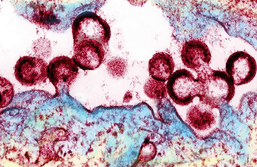 hiv-virions-budding-and-releasing.jpg