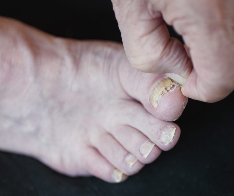 The "Foot Slugging" Trend: Are Your AI Searches and At-Home Hacks Causing Toenail Fungus?