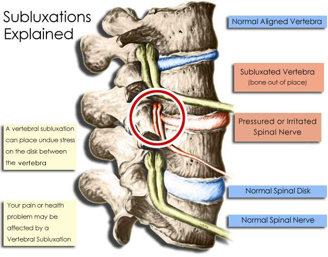 subluxation diagram.jpg