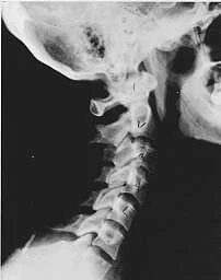subluxation_near_normal.jpg