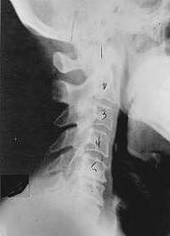subluxation_phase_two.jpg