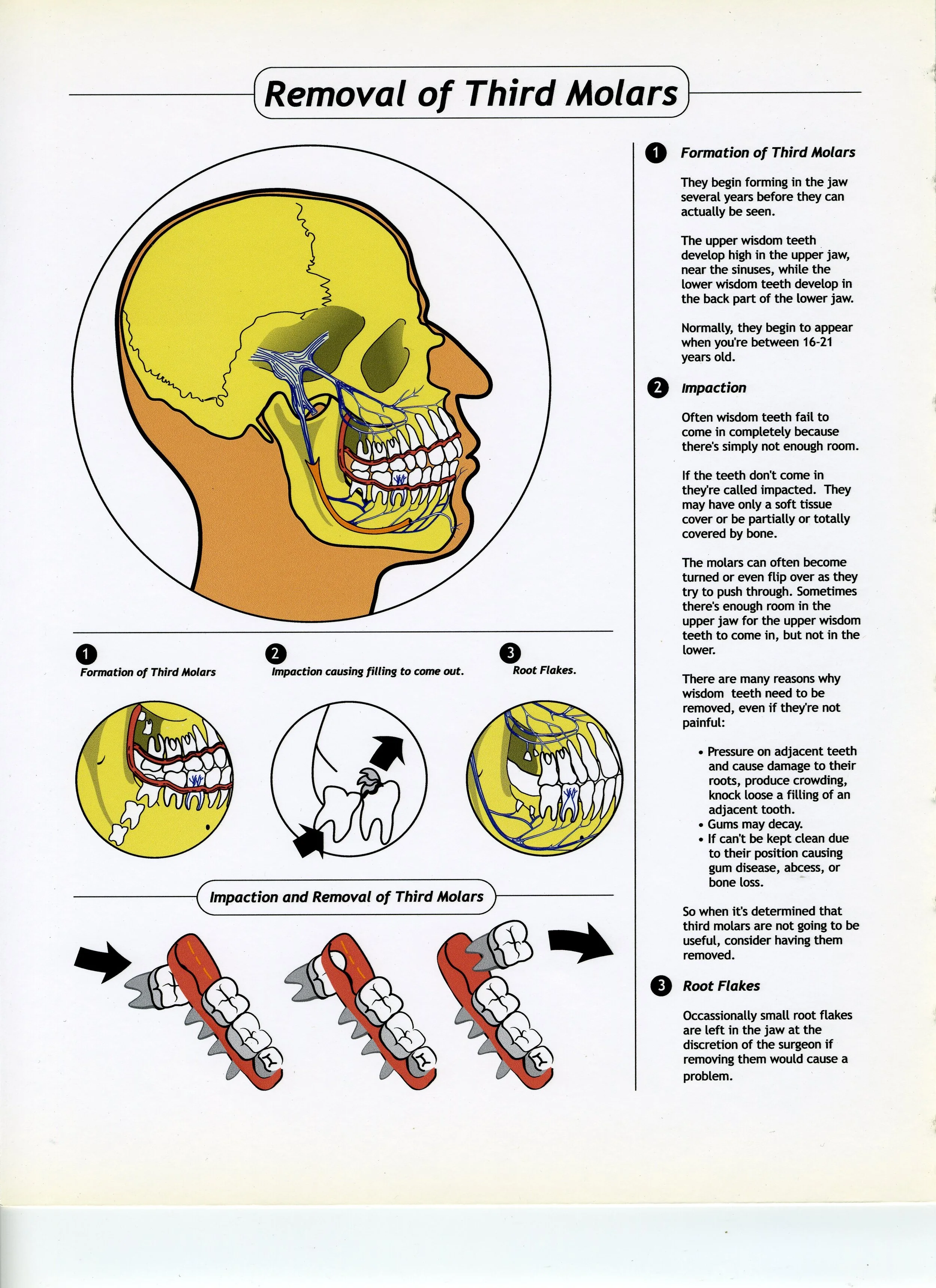 Removal of 3rd Molar Infographic